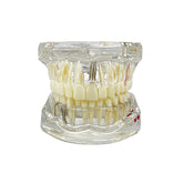 Dental Implant & Disease Demonstration Model - Transparent Jaw with Removable Teeth for Patient Education