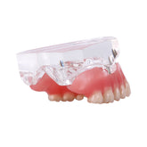 Dental Overdenture Implant Demonstration Model - Clear Jaw Upper/Lower Dentist Student Learning