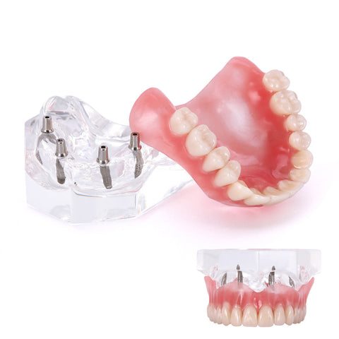 Dental Overdenture Implant Demonstration Model - Clear Jaw Upper/Lower Dentist Student Learning