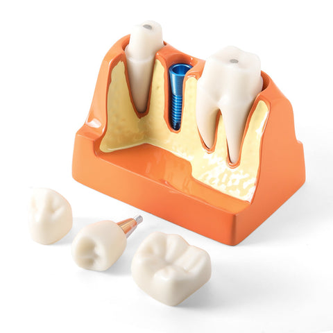 Dental 4x Enlarged Implant Crown Bridge Teaching Model - Removable Veneer Abutment Demonstration