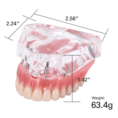Dental Overdenture Implant Demonstration Model - Clear Jaw Upper/Lower Dentist Student Learning