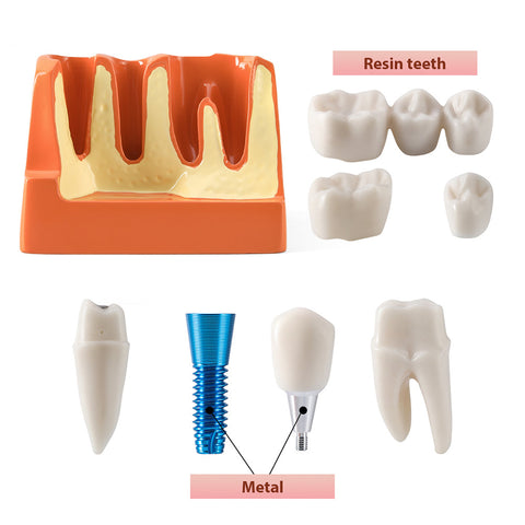 Dental 4x Enlarged Implant Crown Bridge Teaching Model - Removable Veneer Abutment Demonstration
