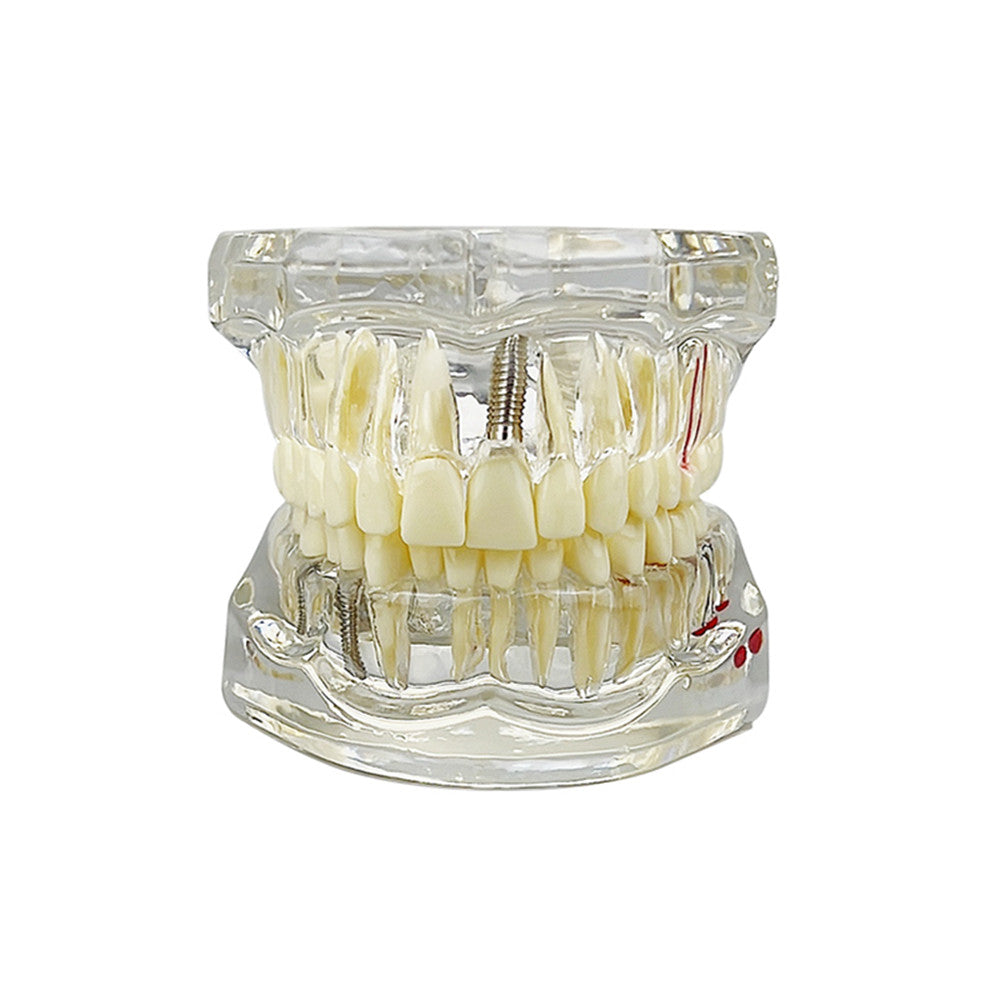 Dental Implant & Disease Demonstration Model - Transparent Jaw with Removable Teeth for Patient Education