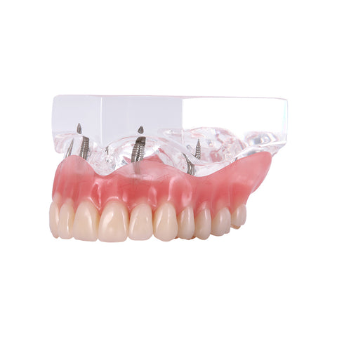 Dental Overdenture Implant Demonstration Model - Clear Jaw Upper/Lower Dentist Student Learning