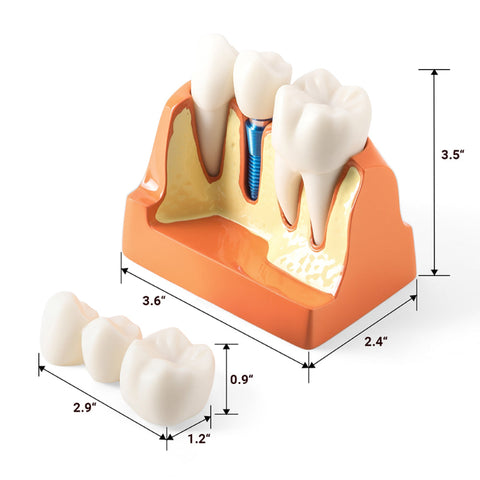 Dental 4x Enlarged Implant Crown Bridge Teaching Model - Removable Veneer Abutment Demonstration