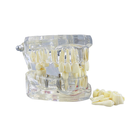 Dental Implant & Disease Demonstration Model - Transparent Jaw with Removable Teeth for Patient Education
