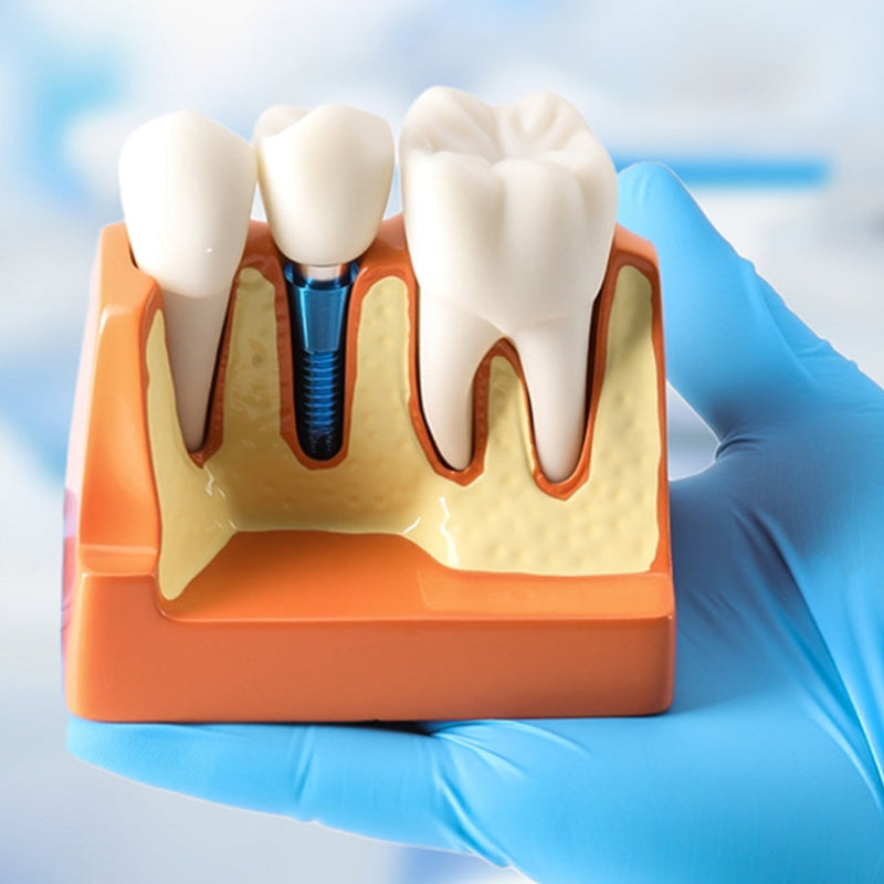 Dental 4x Enlarged Implant Crown Bridge Teaching Model - Removable Veneer Abutment Demonstration