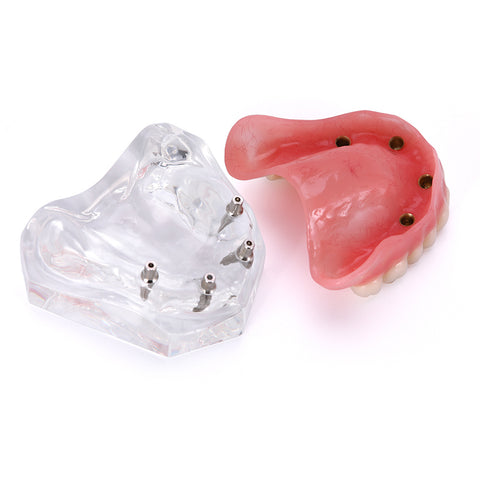Dental Overdenture Implant Demonstration Model - Clear Jaw Upper/Lower Dentist Student Learning