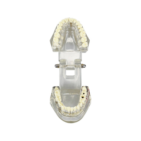 Dental Implant & Disease Demonstration Model - Transparent Jaw with Removable Teeth for Patient Education