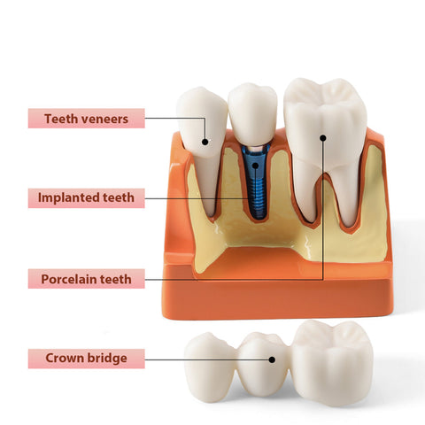 Dental 4x Enlarged Implant Crown Bridge Teaching Model - Removable Veneer Abutment Demonstration