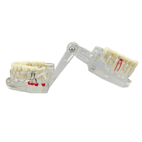 Dental Implant & Disease Demonstration Model - Transparent Jaw with Removable Teeth for Patient Education