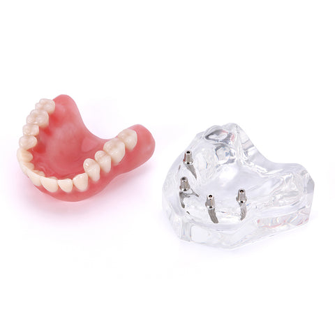 Dental Overdenture Implant Demonstration Model - Clear Jaw Upper/Lower Dentist Student Learning