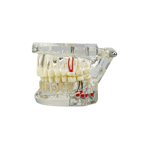 Dental Implant & Disease Demonstration Model - Transparent Jaw with Removable Teeth for Patient Education