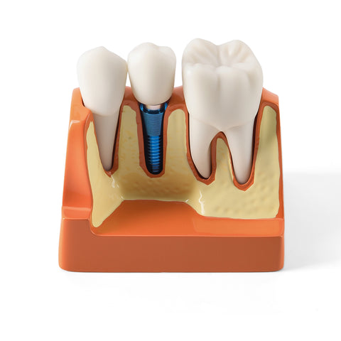 Dental 4x Enlarged Implant Crown Bridge Teaching Model - Removable Veneer Abutment Demonstration