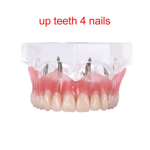 Dental Overdenture Implant Demonstration Model - Clear Jaw Upper/Lower Dentist Student Learning