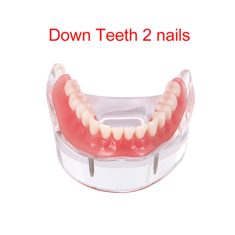 Dental Overdenture Implant Demonstration Model - Clear Jaw Upper/Lower Dentist Student Learning