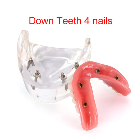 Dental Overdenture Implant Demonstration Model - Clear Jaw Upper/Lower Dentist Student Learning